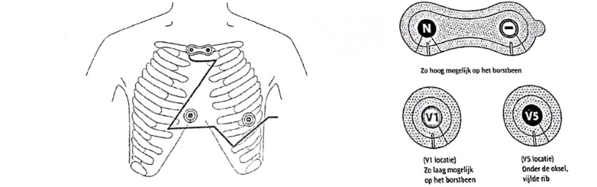 Holterregistratie-plakkers.jpg